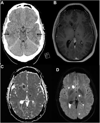 Case Report: Subtherapeutic Vancomycin and Meropenem Concentrations due to Augmented Renal Clearance in a Patient With Intracranial Infection Caused by Streptococcus intermedius